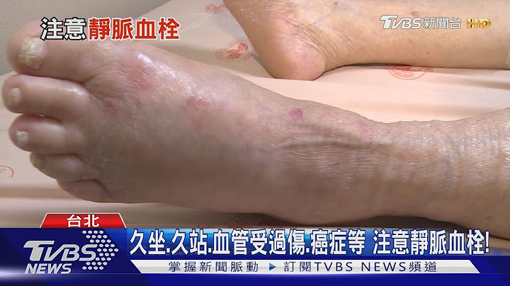【十點不一樣】輕忽這五種..."靜脈血栓"找上門 病情重恐截肢或死亡! - 天天要聞