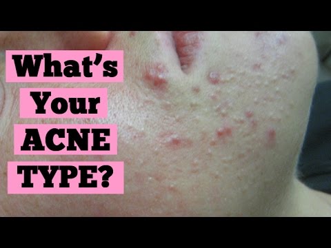 Acne Type: Inflamed Acne or Non Inflamed Acne? | Cysts Blackheads Closed Comedones