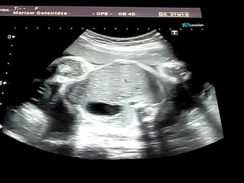 ლილე 7 თვის მუცლადყოფნის დროს