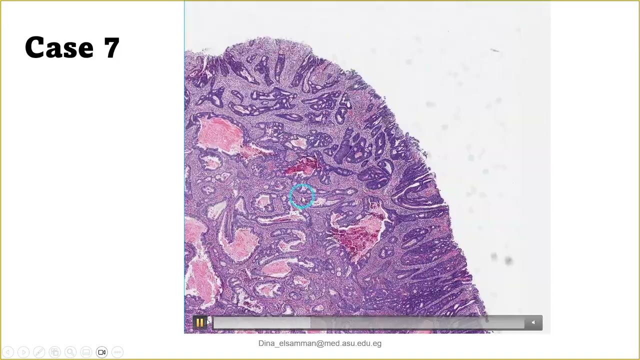 Case (LI7): Adenocarcinoma on top of HGD