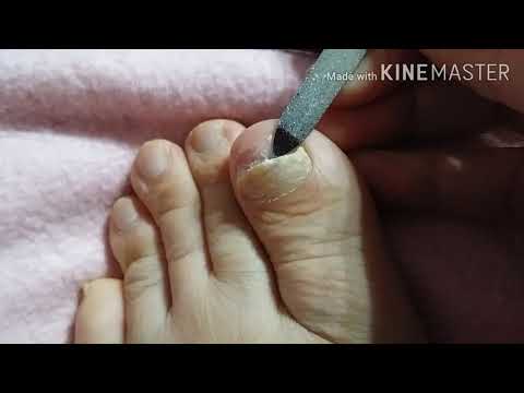 طريقه علاج فطريات الأظافر