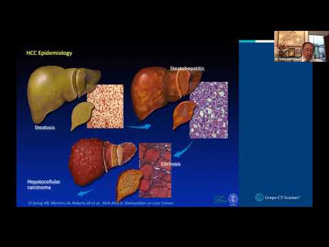 Vídeo: Per què es produeix el carcinoma hepatocel·lular?