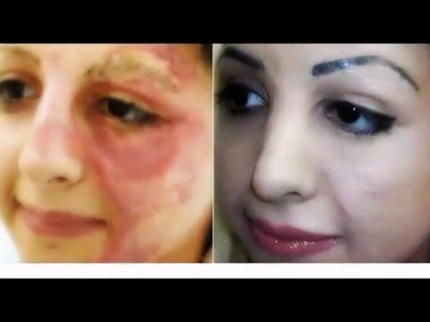 Video: Duma De Stat A Găsit Periculos Să Mascheze Cicatricile Provocate De Violența Domestică Cu Un Tatuaj Din Cauza Posibilității De A Dezvolta Cancer