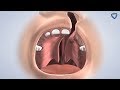 Cleft Lip & Palate in Kennewick WA: Dr. Teeples | Columbia Basin Oral & Maxillofacial Surgeons