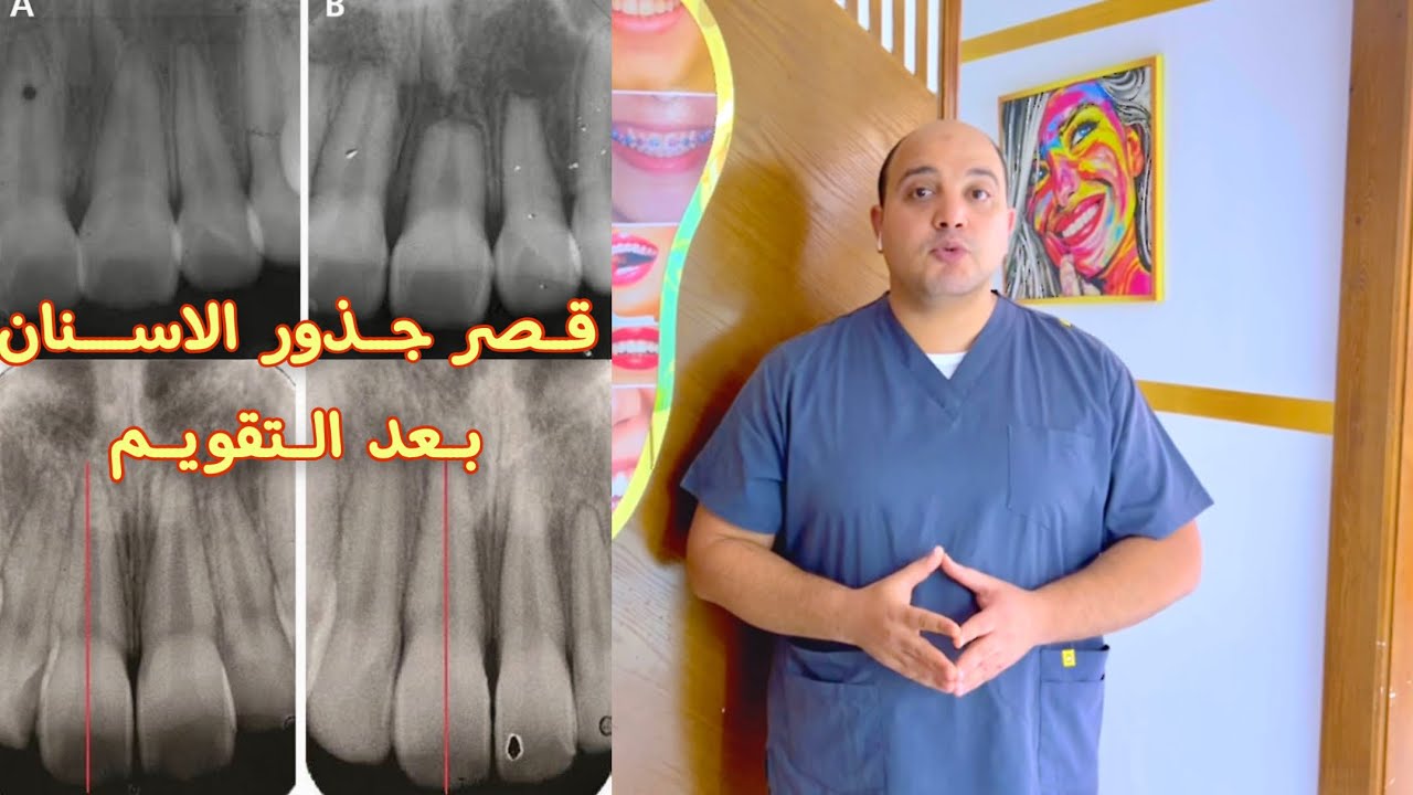 قصر جذور الأسنان بعد التقويم - Root Resorption - تقويم الاسنان مع دكتور اسلام نبيل