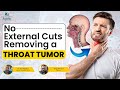 Tumor Blocking 90% of Throat Removed Without External Cuts | Transoral Surgery | Apollo Hospital