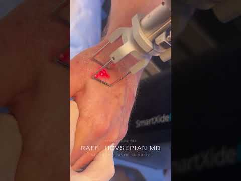 Hand Rejuvenation with Advanced Laser Technology