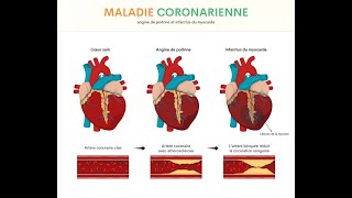 angine de poitrine Angor stable meilleure explication