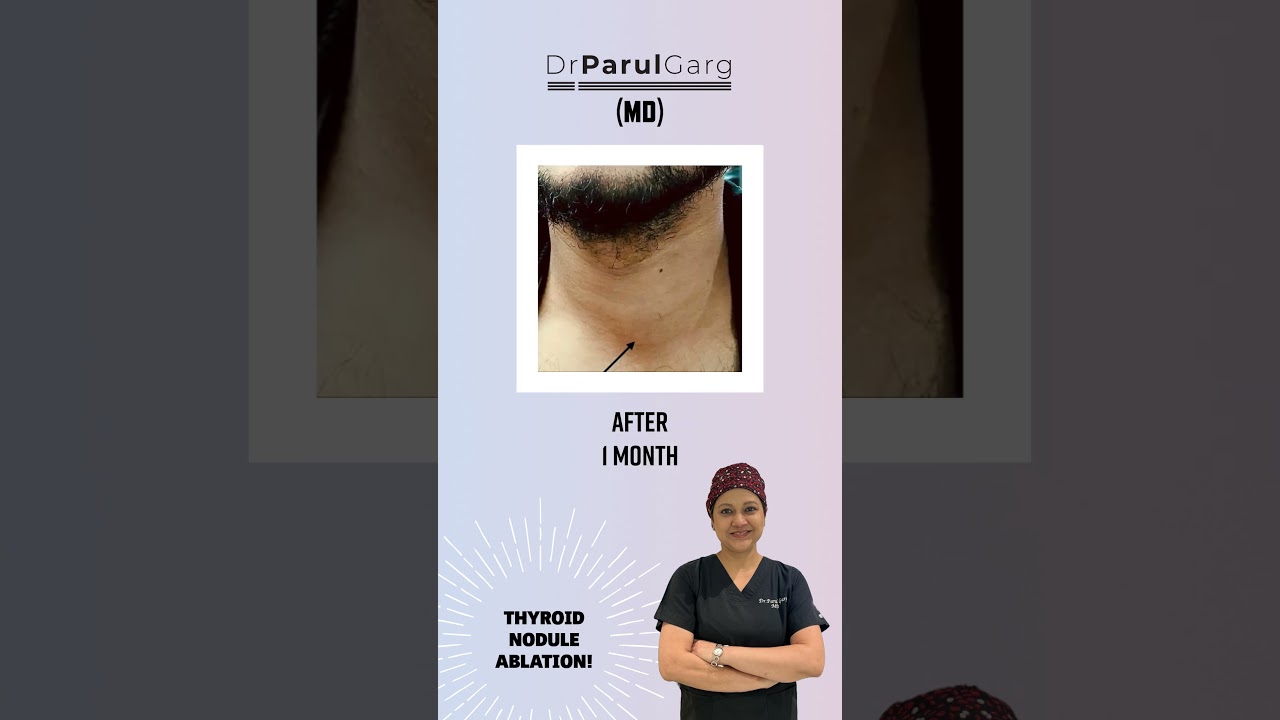Thyroid Nodule Ablation: Stunning Before and After Results with Dr. Parul Garg