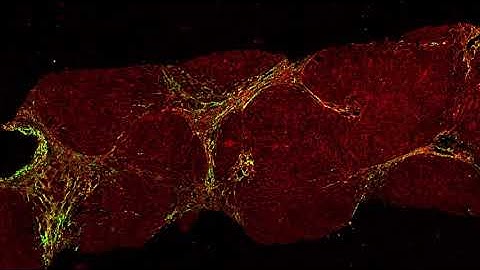 SHG imaging: Liver ACLF (Whole slide imaging)