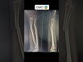 "Real case 🏥 Batao fracture ka type kya hai?" #radiologydiagnostichub #xray  #fracture