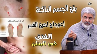 حقيقة البقع الداكنة في الجسم \ بروز عظام اصبع القدم | السبب الحقيقي للفتق