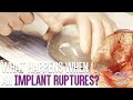 What If A Saline Implant Ruptures? | Brown Plastic Surgery