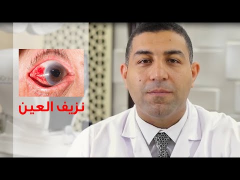 نزيف العين 