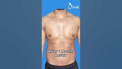 Gynecomastia Surgery in Delhi! Grade 2A Amazing Gynecomastia Result Month by Month #dramitgupta