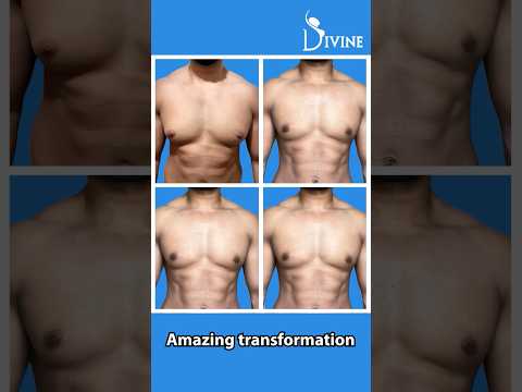 Gynecomastia Surgery in