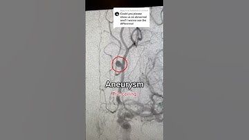 Cerebral Angiogram