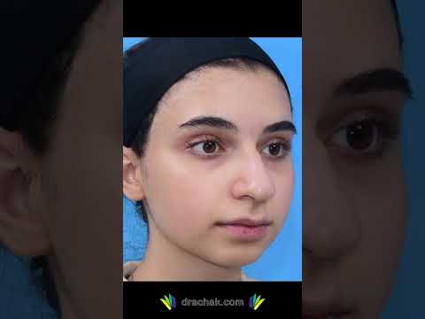 عمل زیبایی بینی گوشتی دکتر فرشید آچاک