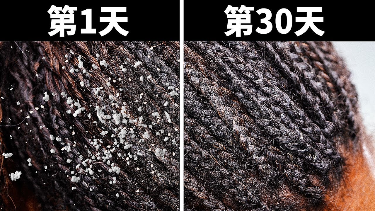 10種在家迅速去除頭皮屑的天然方法 Youtube