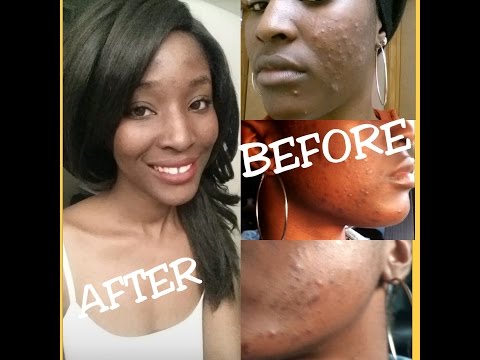 How I Cleared my Acne(Cyst) & Dark spots in week (cHECK OUT MY RECENT VIDEOS)