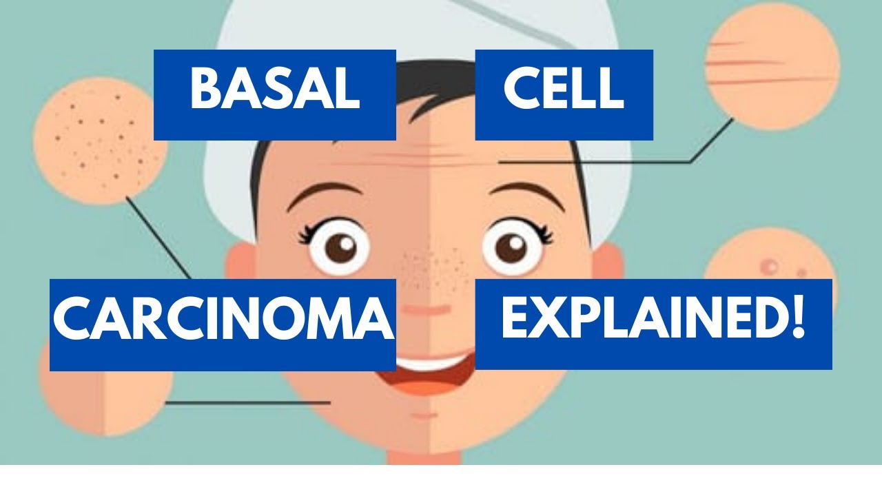 Ultimate Lecture For Everything about Basal Cell Carcinoma! YouTube