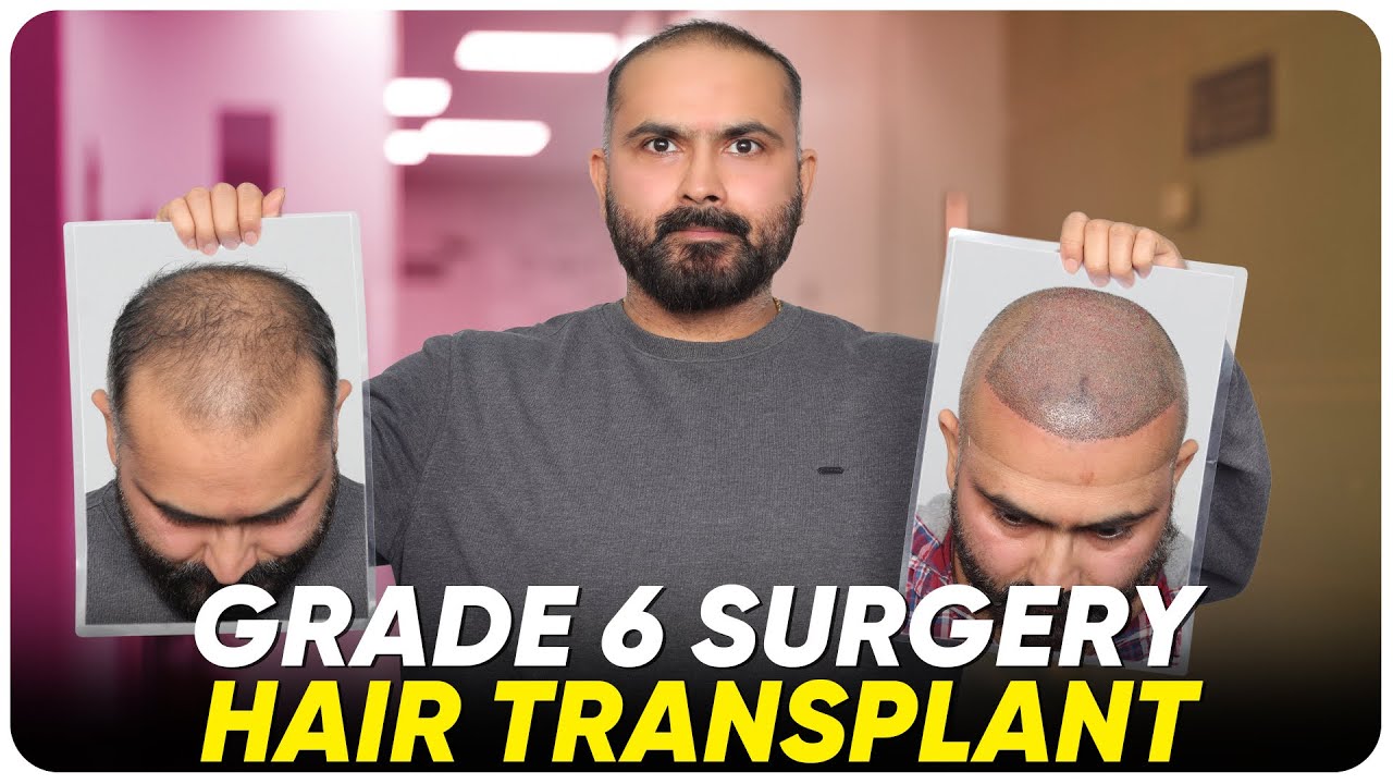 Hair Transplant in Chennai Best Results & Cost of Hair Transplant in