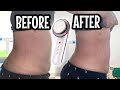 Ultrasonic Fat Cavitation Before And After