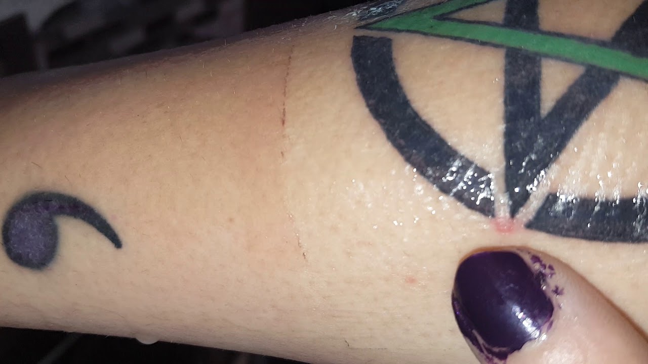 Removing A New Tattoo