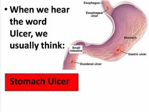 Video: Sår I Sängen (Decubitus Ulcers): Orsaker Och Behandlingar