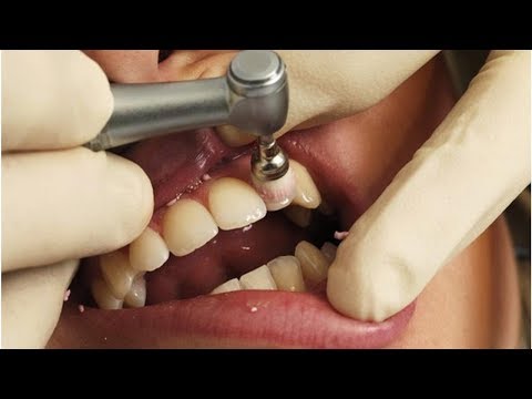 Everything You Need to Know About Tooth Polishing | Tita TV