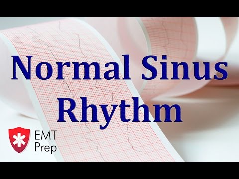 Normal Sinus Rhythm