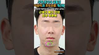 무턱 환자의 공통점 이중턱과 호두 주름 개선법 #shorts