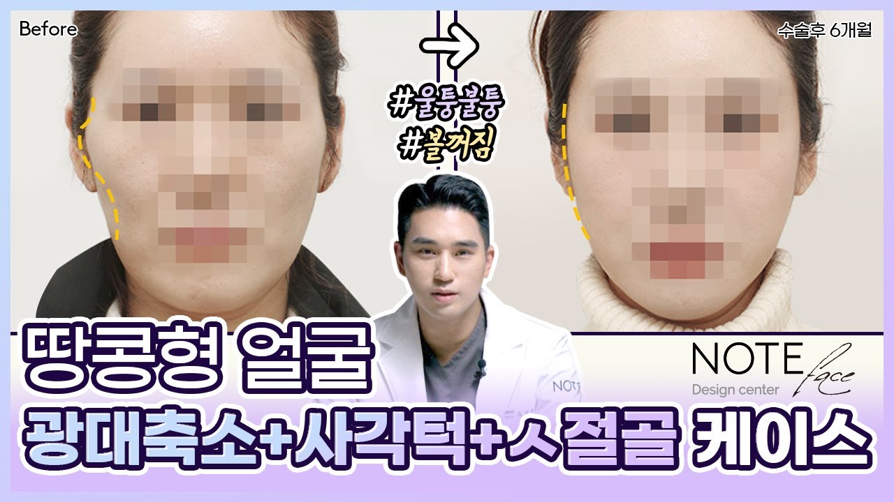 [유.케.리] 📍 CT로 보는 케이스 리뷰 l 광대 축소 l 볼패임 필러 l 지방이식 l