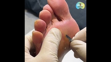 Corn removal using scalpel debridement