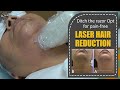 Facial Laser Hair Reduction for excessive hair growth | Procedure Video