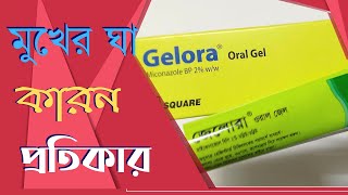 Why do mouth ulcers occur? | How to get rid of them | GELORA ORAL GEL | Square Pharmaceuticals Ltd