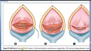 Obstetrics 693 c Steps Of Cesarean Section Incision Delivery of baby repair of CSection Operation