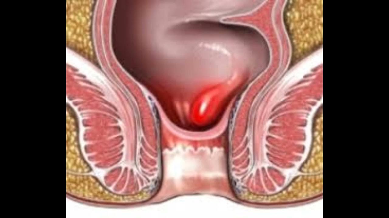 Трещина болит. Геморроидальное кровотечение. Анальное отверстие у женщин.