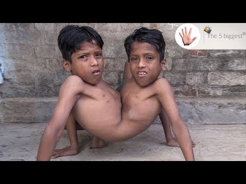 Video: Indiase Siamese Tweeling Shivanath En Shivram - Alternatieve Mening