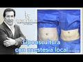 Lipoescultura con Anestesia Local en Clínica del Rey - Dr. Franco Reyes Jácome