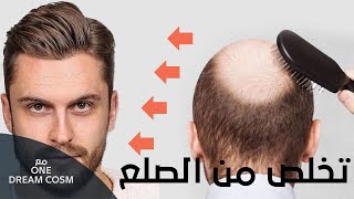 لن تصدق كيف تخلص من الصلع و اصبح لديه شعر (hair extension)