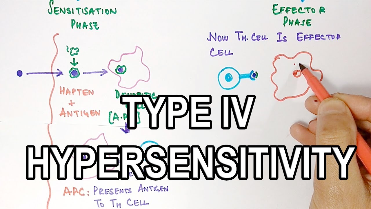 Types Of Hypersensitivity Chart