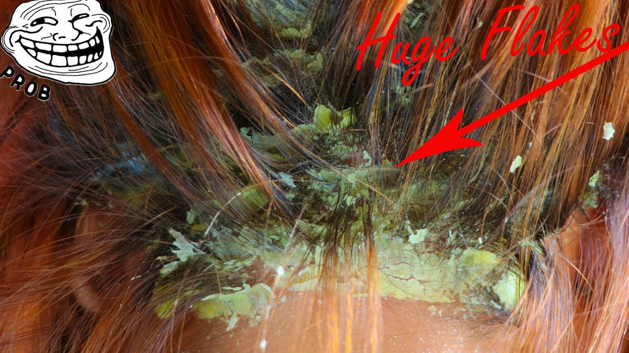Picking Big Scalp Flakes Psoriasis Huge Dandruff Flakes Removal, Itchy Dry Scalp Scratching