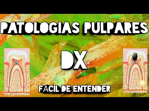 Patologías Pulpares -