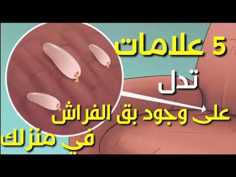 فيديو: كيف تجد البق