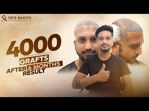From Hair Loss to a Natural Look 😍 | Hair Transplant in Lucknow | New Roots
