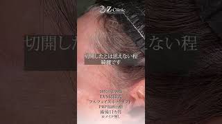 50代のフェイスリフトの傷跡：長い傷がありますが、見えますか？？：切開リフト