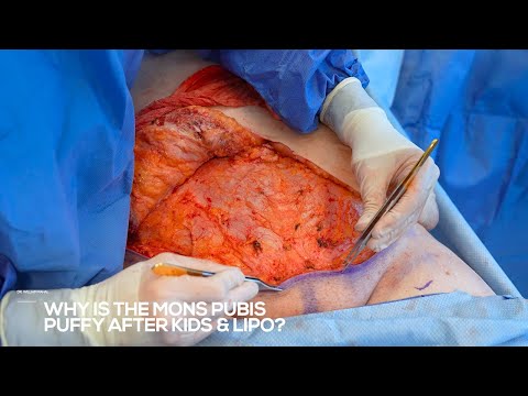 Why Is The Mons Pubis Puffy After Kids and/or Liposuction? Live