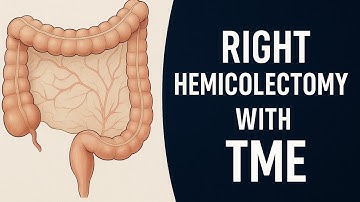 Laparoscopic Right Hemicolectomy with Total Mesocolic Excision (TME) – Step-by-Step.