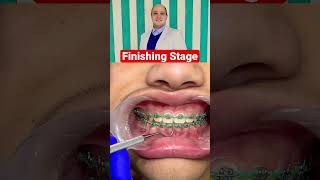 مرحلة ال finishing  في تقويم الاسنان